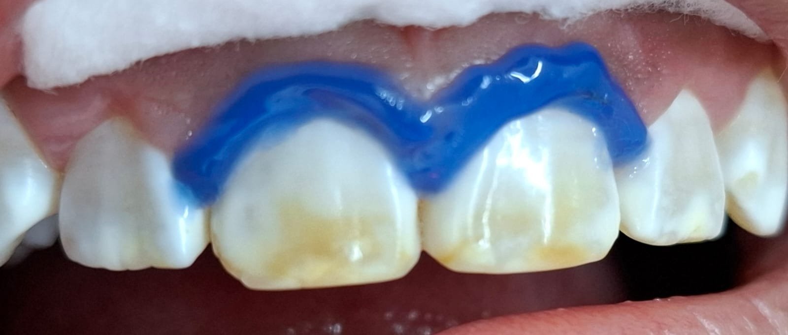 Sonrisa antes del tratamiento