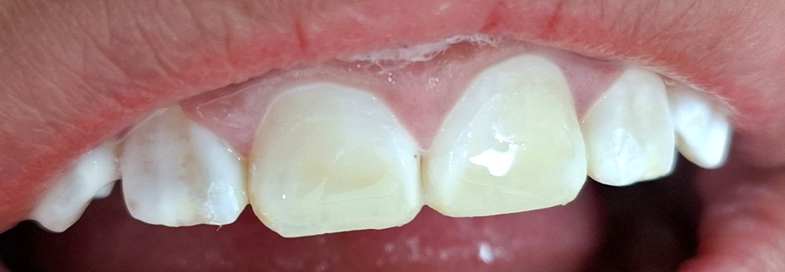 Sonrisa después del tratamiento